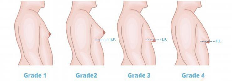 Различные упражнения для груди не уменьшат гинекомастию или мужскую грудь