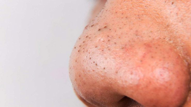 5 męskich sposobów usuwania zaskórników z twarzy