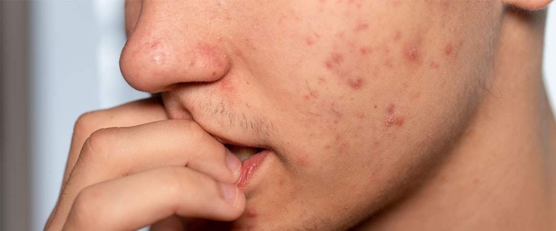El acné y las espinillas son dos cosas diferentes y esto es lo que los hombres deben saber para tratarlos