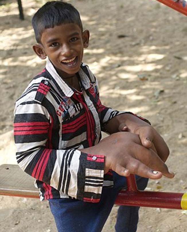 Mohammed Kaleem, 8-letni indijski fant z največjimi rokami na svetu