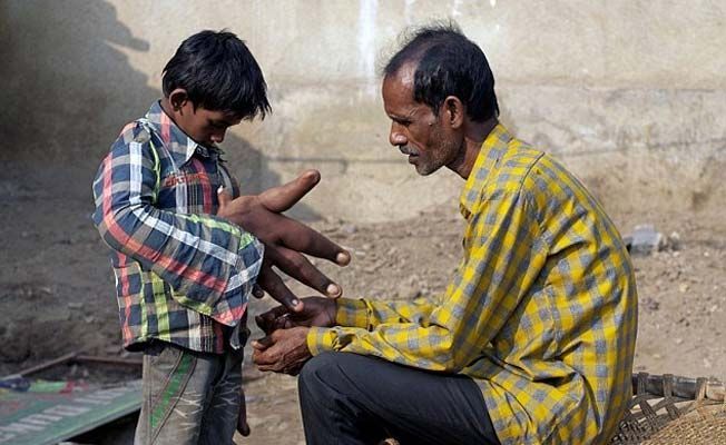 Mohammed Kaleem, el niño indio de 8 años con las manos más grandes del mundo