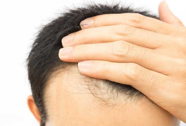 Naturlige måder at vokse hår tilbage fra en tilbagevendende hårlinje