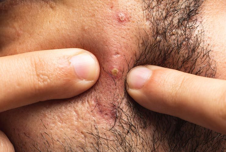 5 semplici modi per sbarazzarsi di brufoli dolorosi sotto la barba
