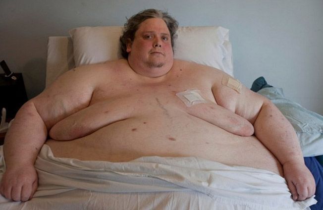 A legtöbb elhízott ember létezik az emberiség történetében